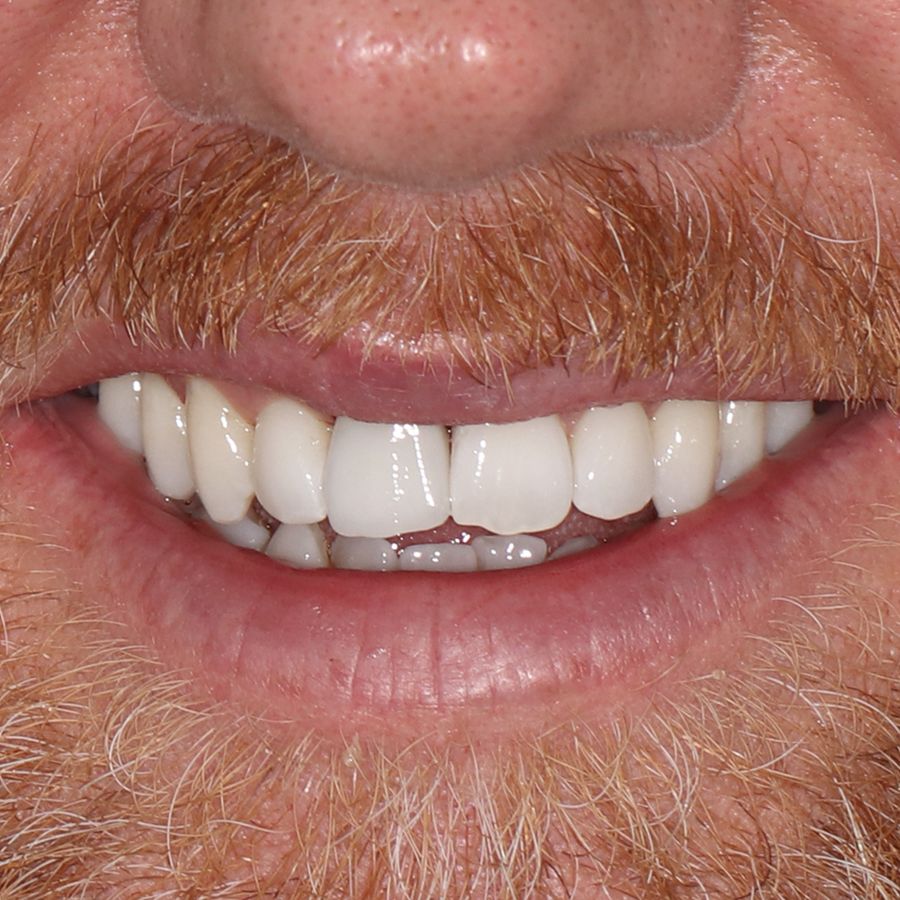 dental crown after 3Dental